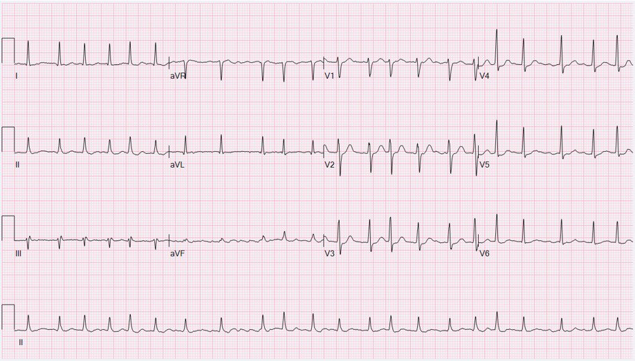 EKG: Atrial Fibrillation