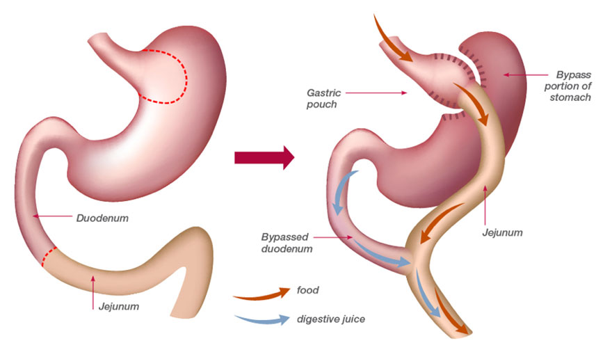 Bariatric Procedure