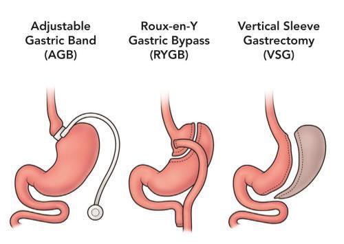 Bariatric Surgery