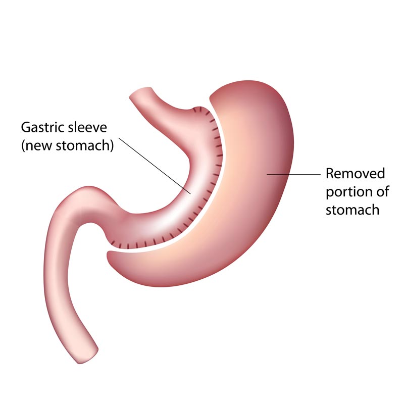 Bariatric Vitamin