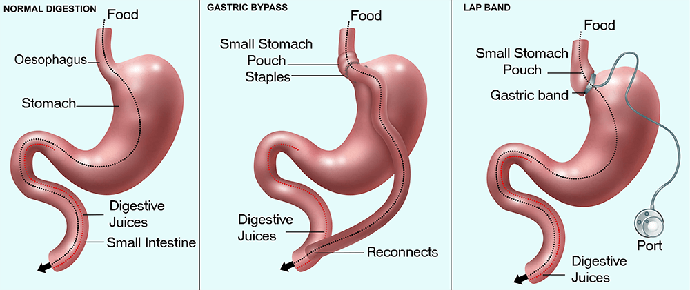 Bariatric Multivitamin Patch