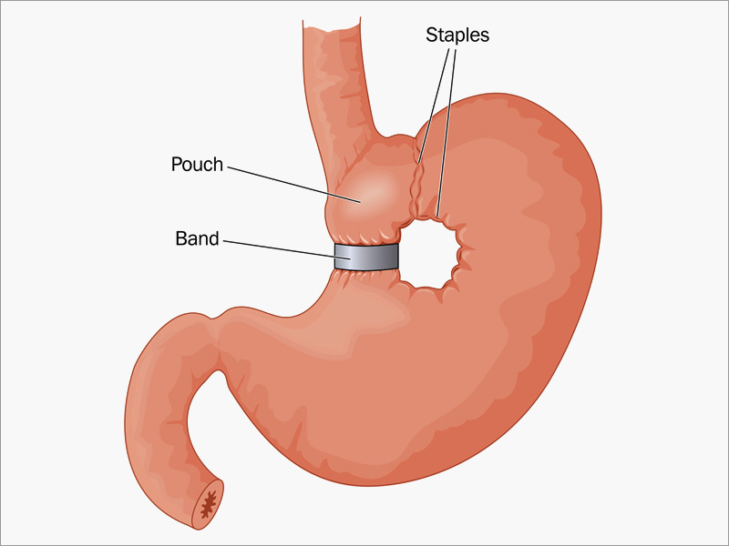 Bariatric Vitamins Without Vitamin K