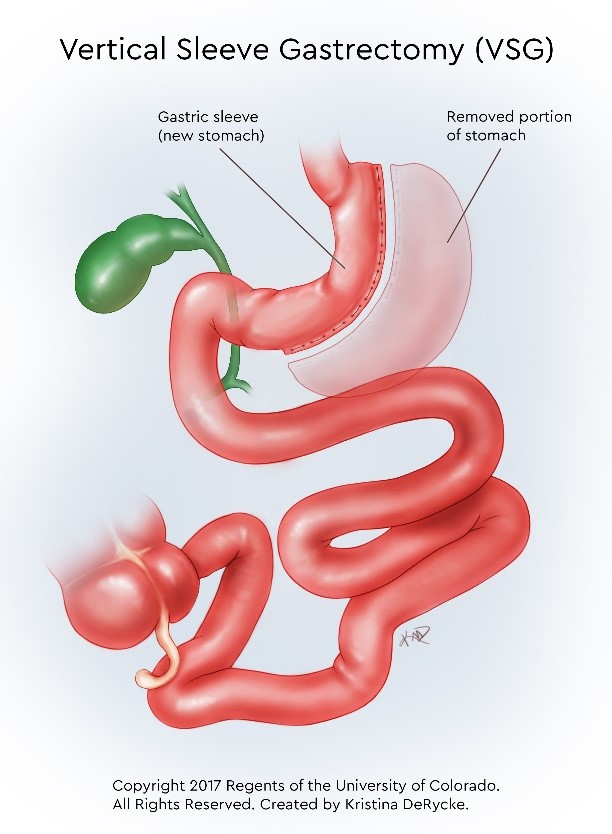 Bariatric Best Vitamins