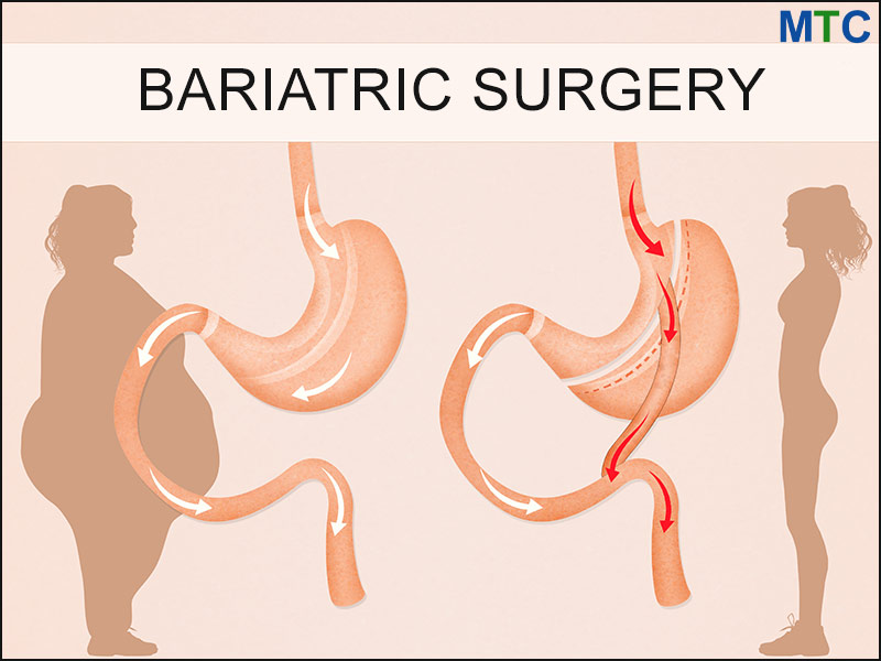 Bariatric Vitamins Vs Prenatal Vitamins