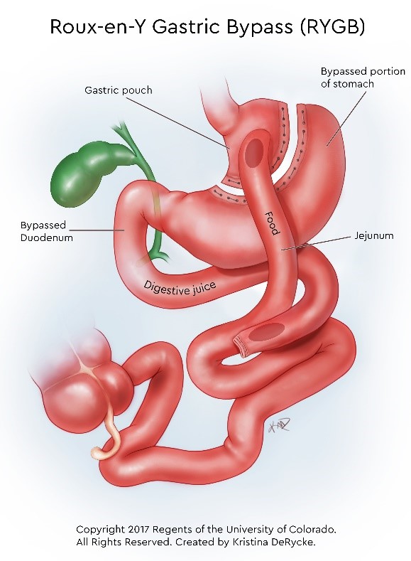 Vitamin For Bariatric