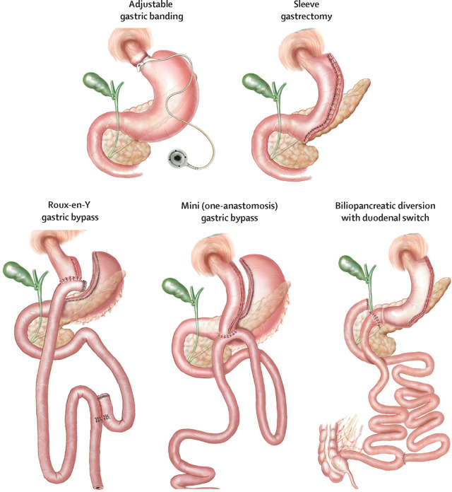 Bariatric Vitamins Usa