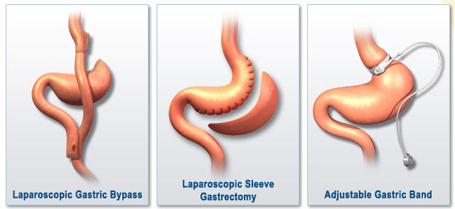 Bariatric Vitamin