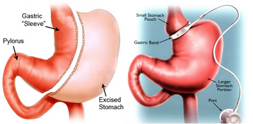 Bariatric Eating Journey Vitamins