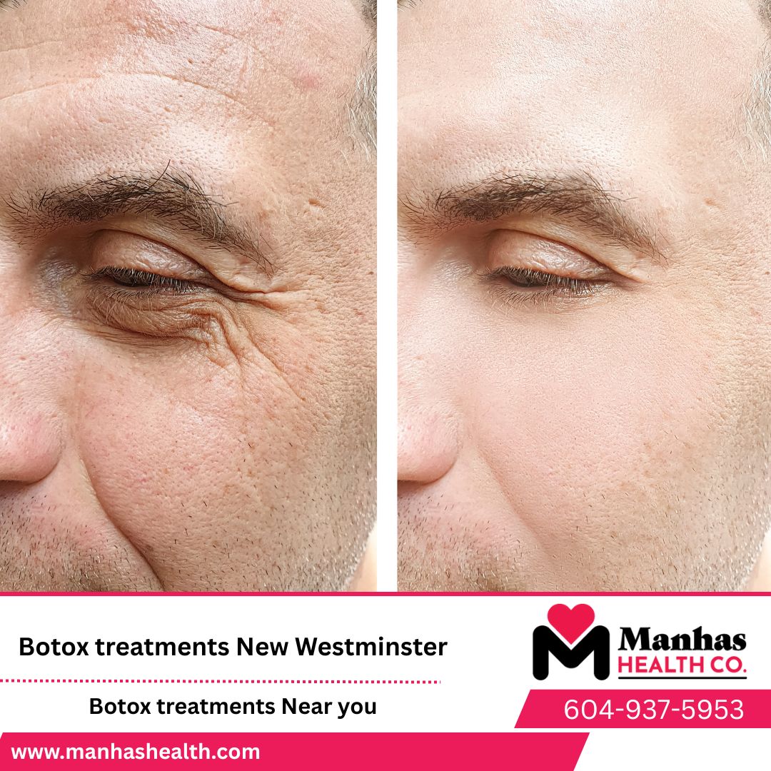 Botox and Filler Areas side effects in Vancouver