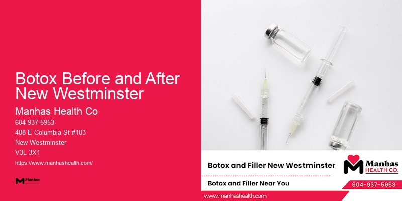 Cosmetic Botox Injections Botox Before and After New Westminster