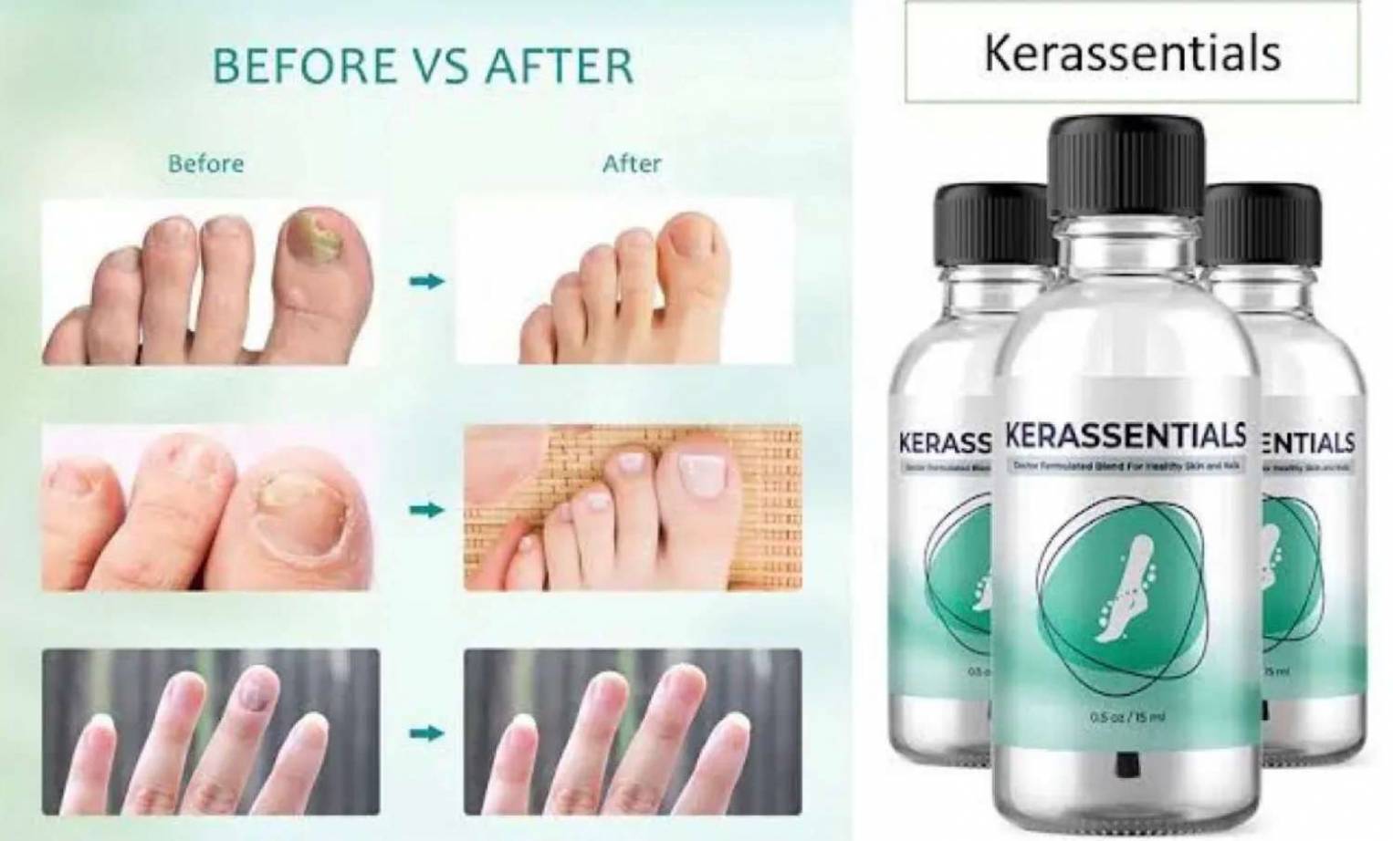 Cost Of Kerassentials