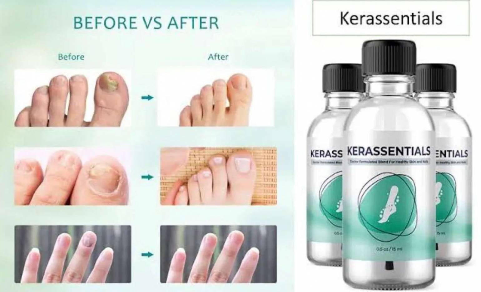Kerassentials Scam Or Legit