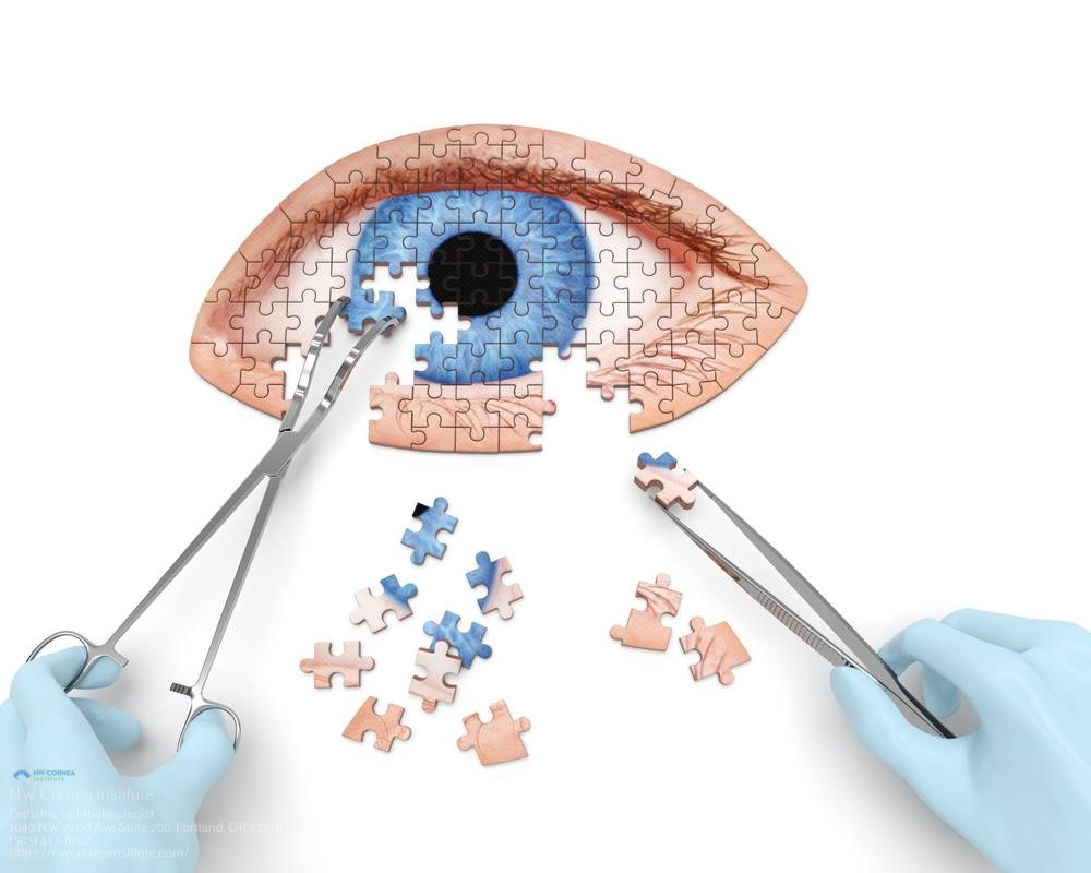 PRK Surgery