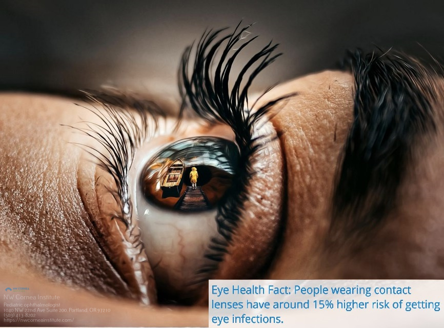 Lasik